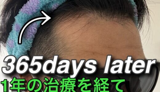 【サブ4ランナーのAGA治療日記.9】治療開始から365日（1年）の現状報告──脱ベジータへの軌跡